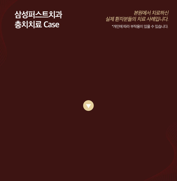 충치치료