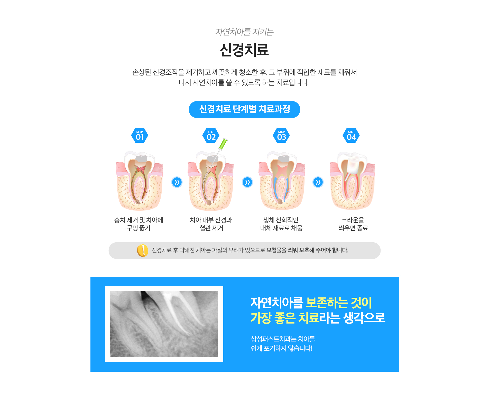 신경치료