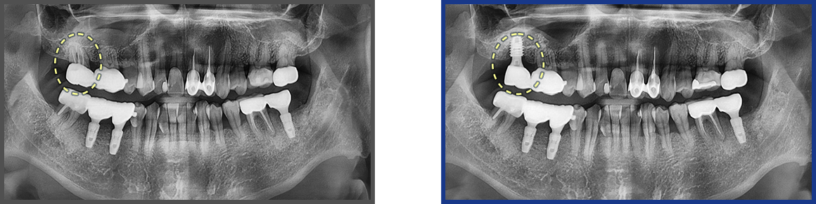 임플란트 증례01