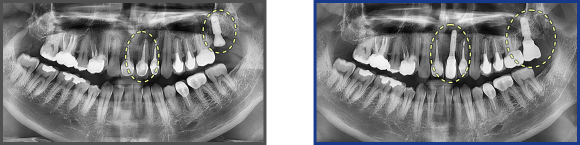 임플란트 증례02
