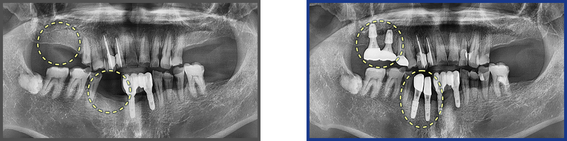 임플란트 증례05