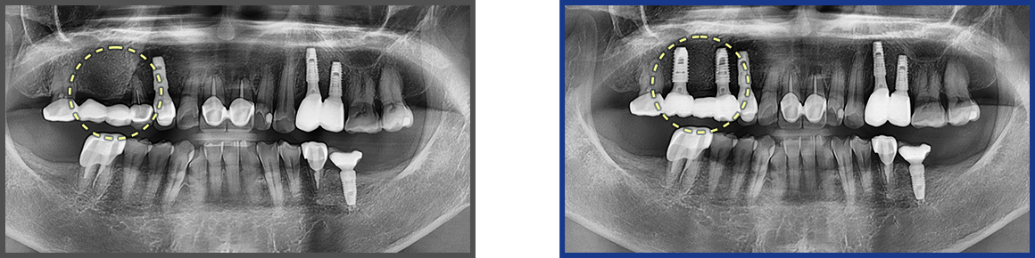 임플란트 증례06