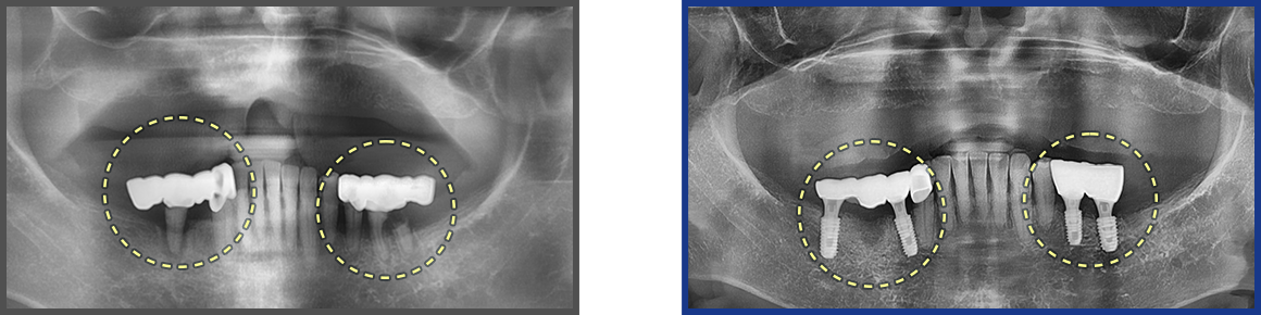 임플란트 증례08