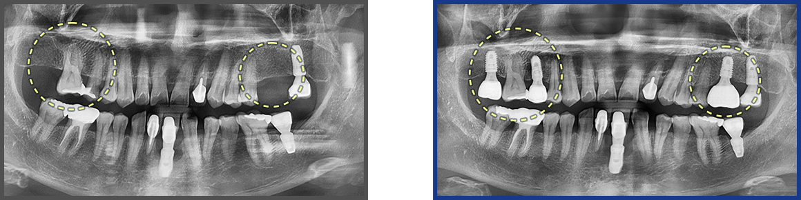 임플란트 증례09