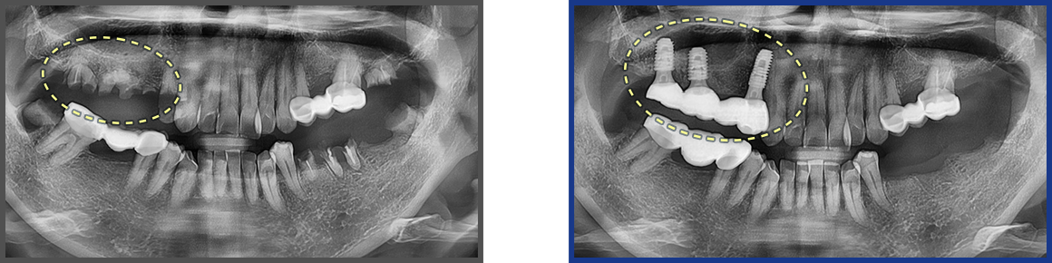 임플란트 증례11