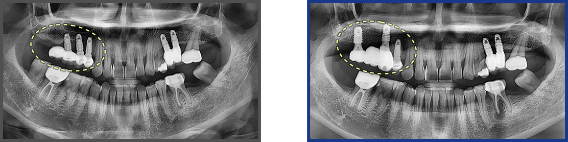 임플란트 증례12