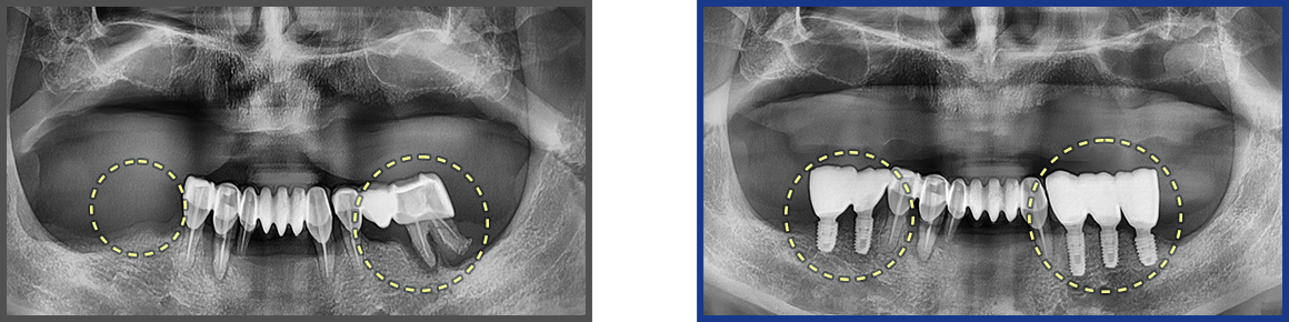 임플란트 증례14