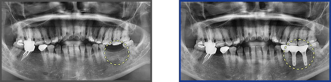 임플란트 증례16