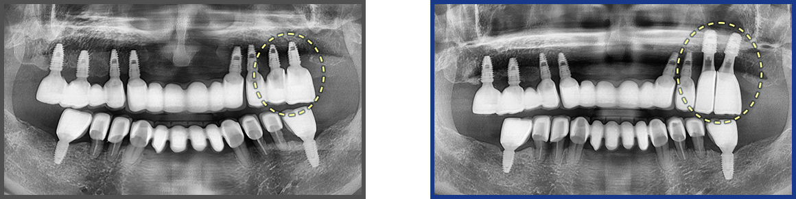 임플란트 증례17
