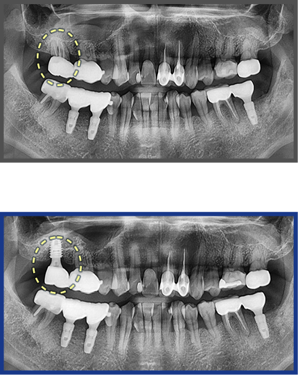 임플란트 증례01
