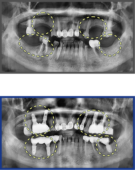 임플란트 증례03