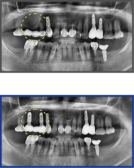 임플란트 증례06