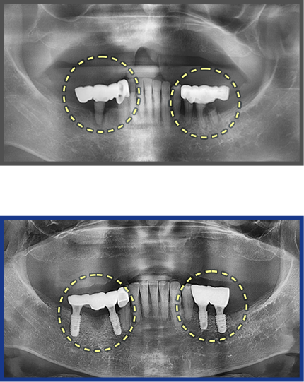 임플란트 증례08