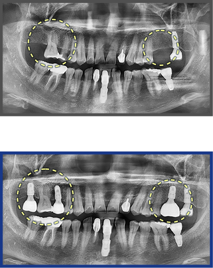 임플란트 증례09