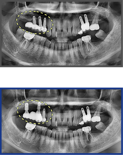 임플란트 증례12