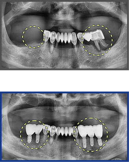 임플란트 증례14