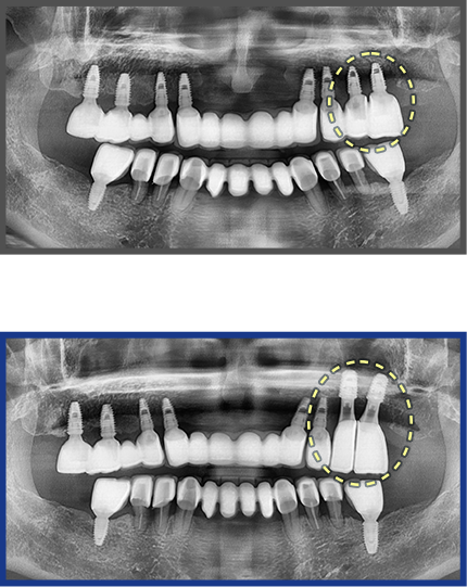 임플란트 증례17