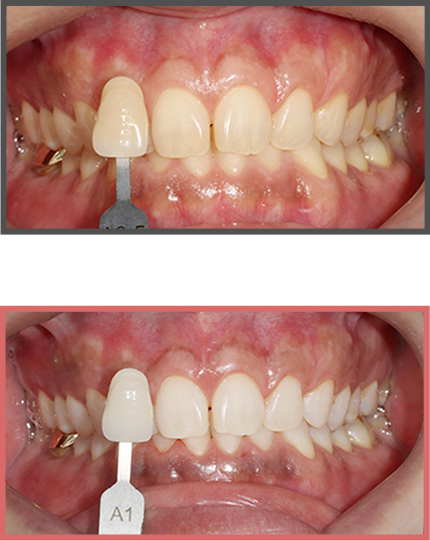 치아미백 증례01
