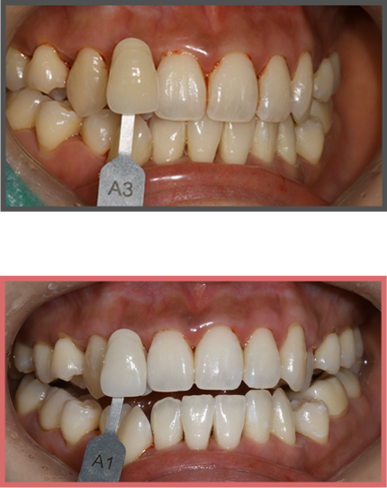치아미백 증례02