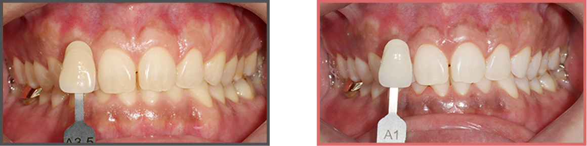 치아미백 증례01