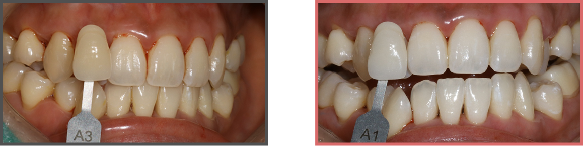 치아미백 증례02