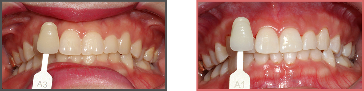 치아미백 증례03
