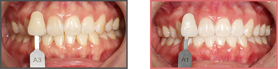 치아미백 증례06